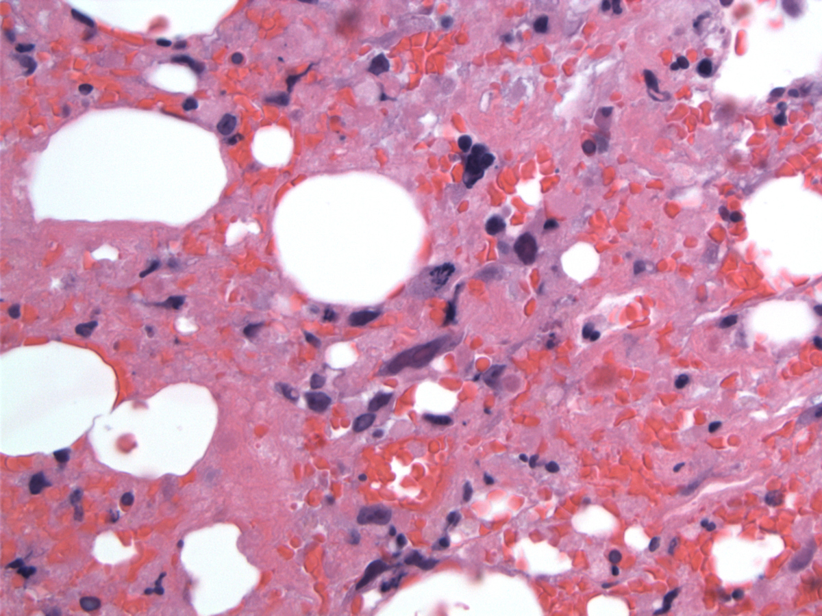 Large atypical lymphoma cells with abnormal mitoses